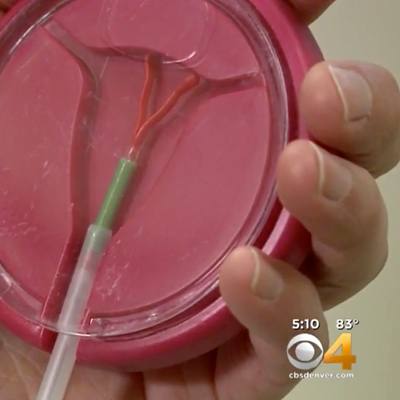 IUD Use Linked to Reduced Risk of Ovarian Cancer